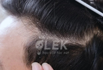 Cách Trị Gàu Và Hói Đầu? – Giải đáp từ các barber